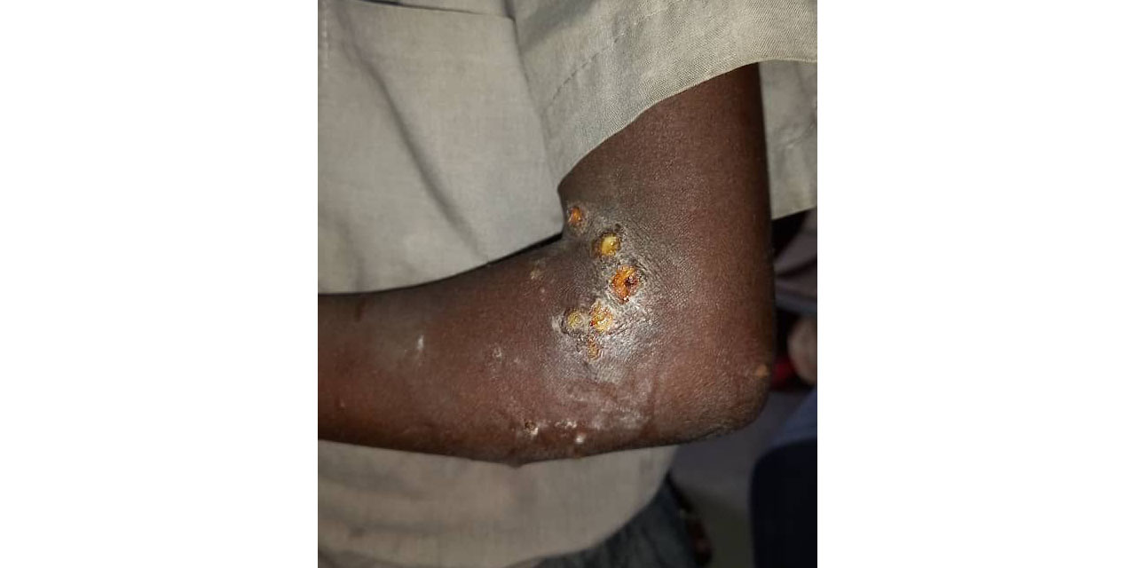 Ohangwena still battling scabies