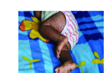 Baby among first two confirmed mpox cases …third case suspected in Rundu as ministry races to procure vaccines