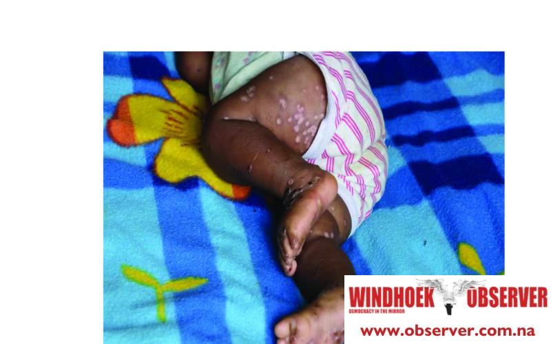 Baby among first two confirmed mpox cases …third case suspected in Rundu as ministry races to procure vaccines