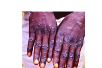 Mpox outbreak declared in Namibia …first case recorded in Swakopmund linked to cross-border travel 