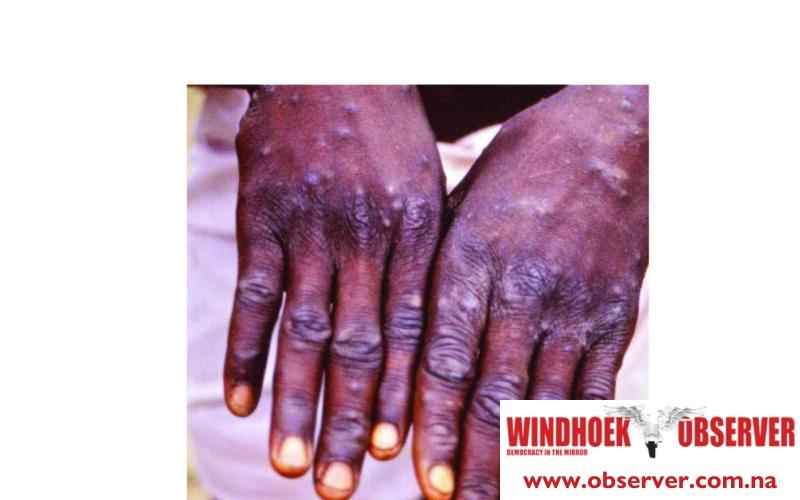 Mpox outbreak declared in Namibia …first case recorded in Swakopmund linked to cross-border travel
