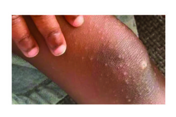 Health ministry confirms 10 measles cases in Kunene